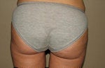Liposuction after 200797