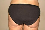 Liposuction before 200797