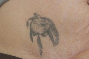 Laser Tattoo Removal Photos before 203267