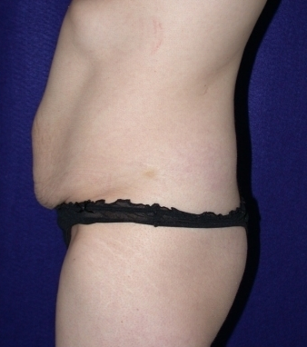 Tummy Tuck 204408