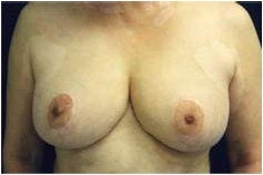 Breast Reduction after 205099