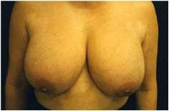 Breast Reduction before 205099