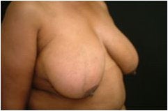 Breast Reduction before 205107