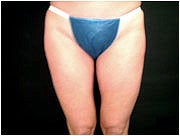 Liposuction after 205388