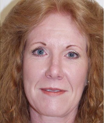 Facelift after 209879