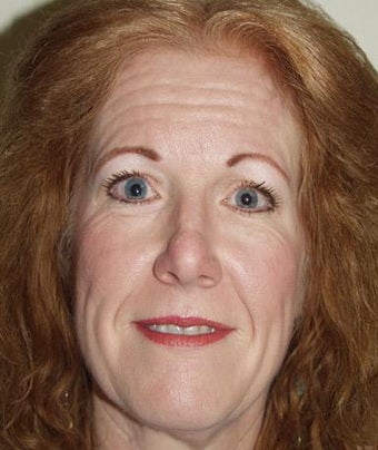 Facelift before 209879