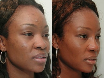 African American Rhinoplasty before 210294