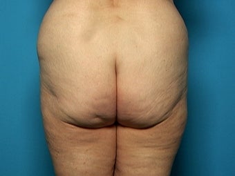 Buttock and Outer Thigh Lift before 212220