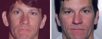 Otoplasty (ear surgery) before 212308