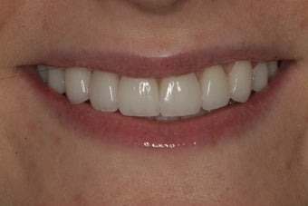 Porcelain Veneers after 213081