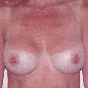 Breast Augmentation after 214430