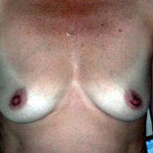 Breast Augmentation before 214430