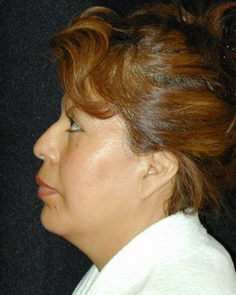 Liposuction of Chin after 214683