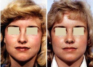 Rhinoplasty before 214825