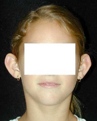Otoplasty - Ear Surgery before 215188