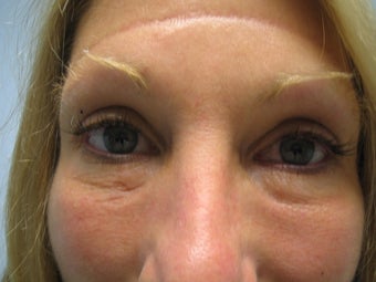 Thermage Eye's before 217145