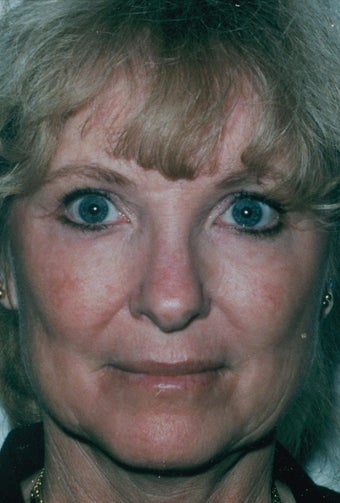 Laser Resurfacing after 218999