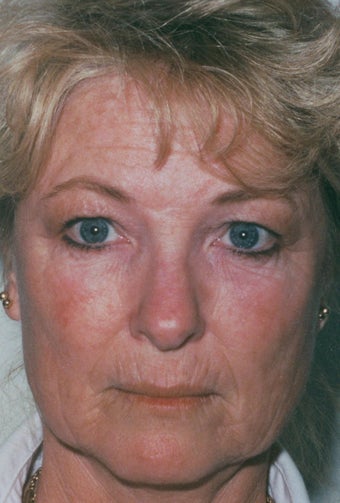 Laser Resurfacing before 218999