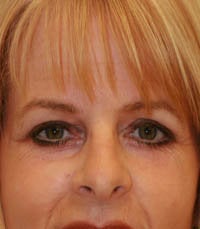 blepharoplasty (eyelids) after 219347