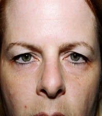 blepharoplasty (eyelids) before 219347