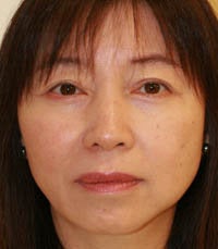 blepharoplasty (eyelids) after 219349