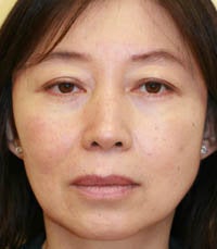blepharoplasty (eyelids) before 219349