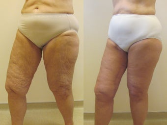 Circumferential thigh lift after 220775