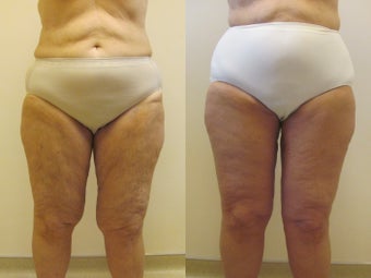 Circumferential thigh lift before 220775