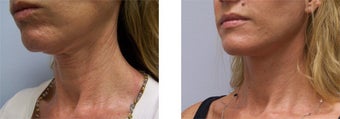 Face and Neck Lift before 220929