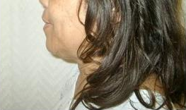 Laser Liposuction 221271