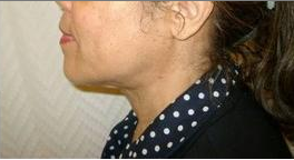 Laser Liposuction 221271