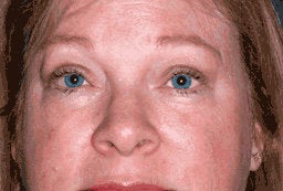 Upper Eyelid Blepharoplasty and Ptosis Repair after 222445