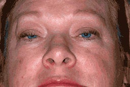 Upper Eyelid Blepharoplasty and Ptosis Repair before 222445