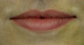Lip Augmentation after 223122