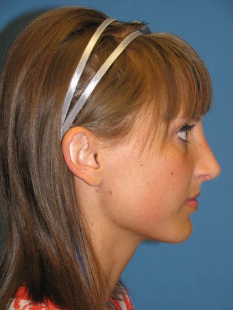 Rhinoplasty after 223696
