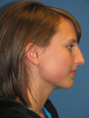 Rhinoplasty before 223696