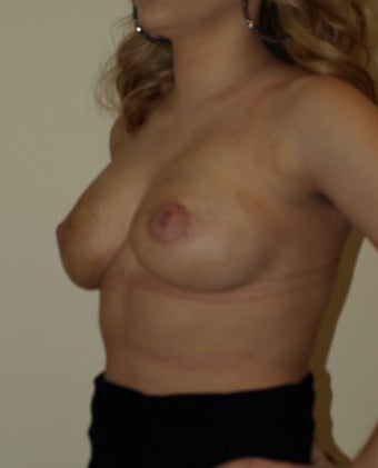 Goes Mastopexy
