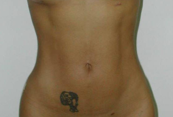 Vaser Liposuction before 229660