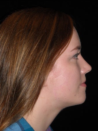 Wide excision and flap closure for melanoma