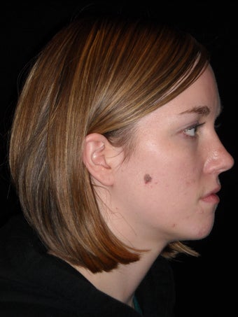 Wide excision and flap closure for melanoma