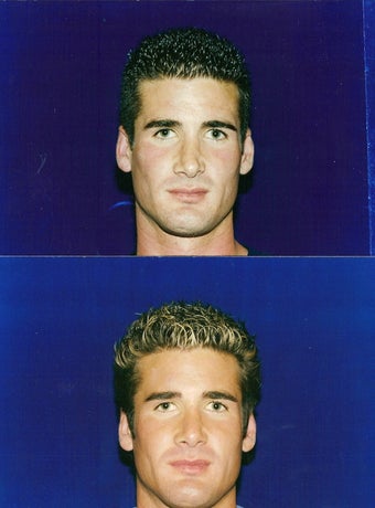 Revision Rhinoplasty before 229780