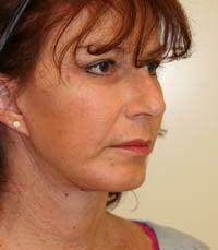 Face and Necklift, Eyelids, Temporal Browlift after 232352