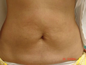 Thermage after 233685