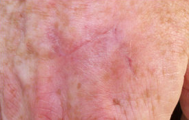 Skin Cancer Surgery on Hand after 561013