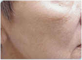 photofacial after 267552
