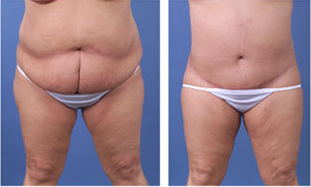 Central body lift with liposuction of thighs and back, age 42 before 6815