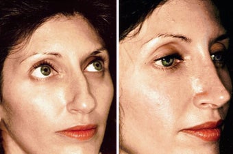 25 year old female, rhinoplasty before 629102