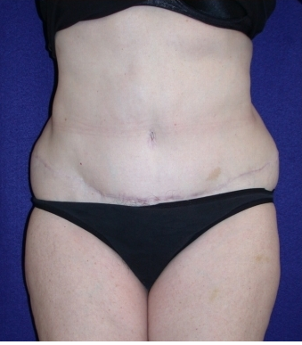 Tummy Tuck (abdominoplasty) after 208467