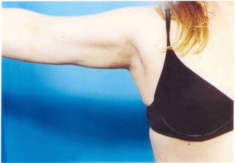 Liposuction after 555647