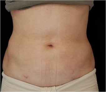 SlimLipo Abdomen Showing Skin Tightening after 97356